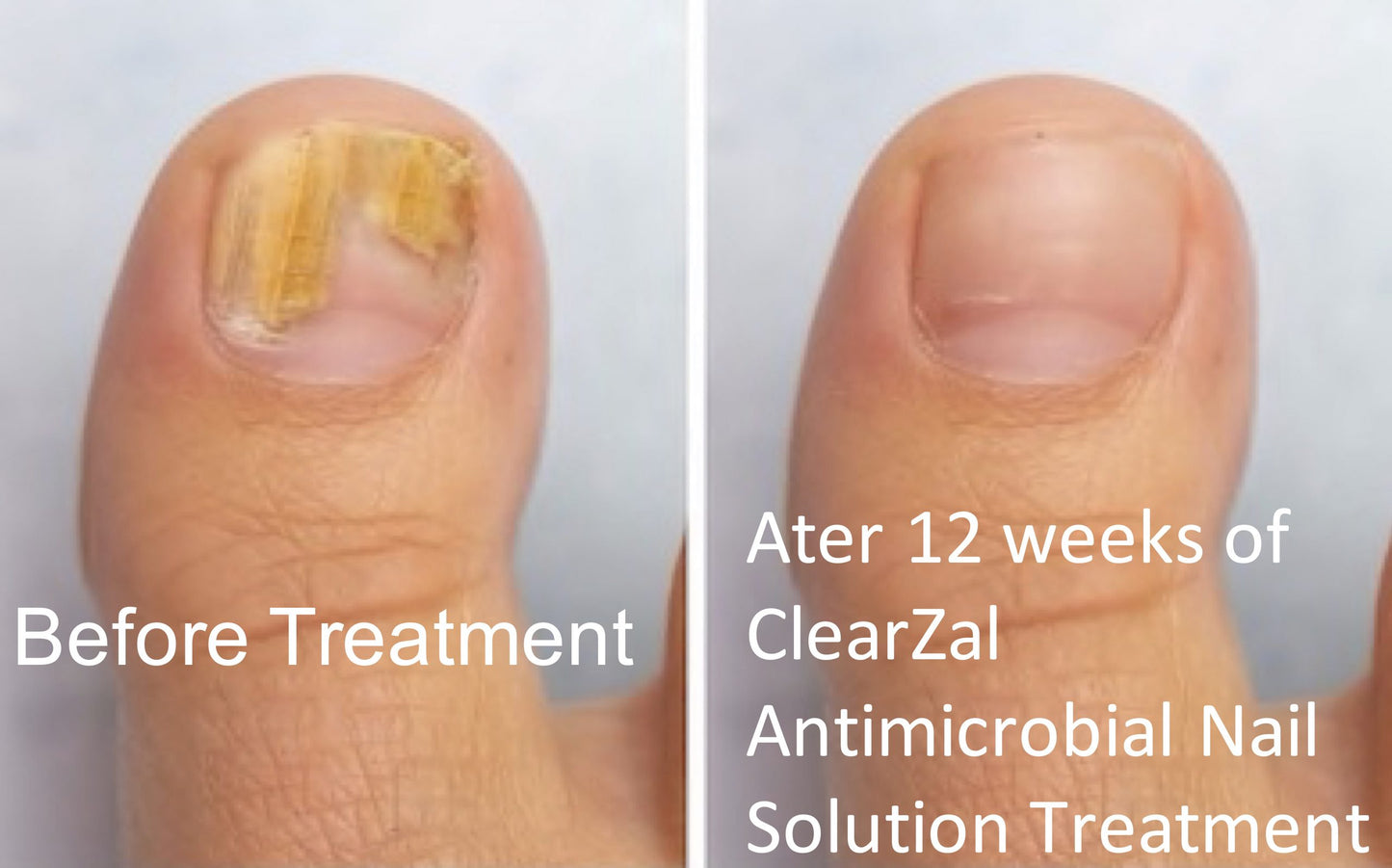 ClearZal® Nail & Foot Kit – BAC Antimicrobial Nail Solution w/Foot Sanitiser
