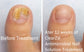 ClearZal® Nail & Foot Kit – BAC Antimicrobial Nail Solution w/Foot Sanitiser