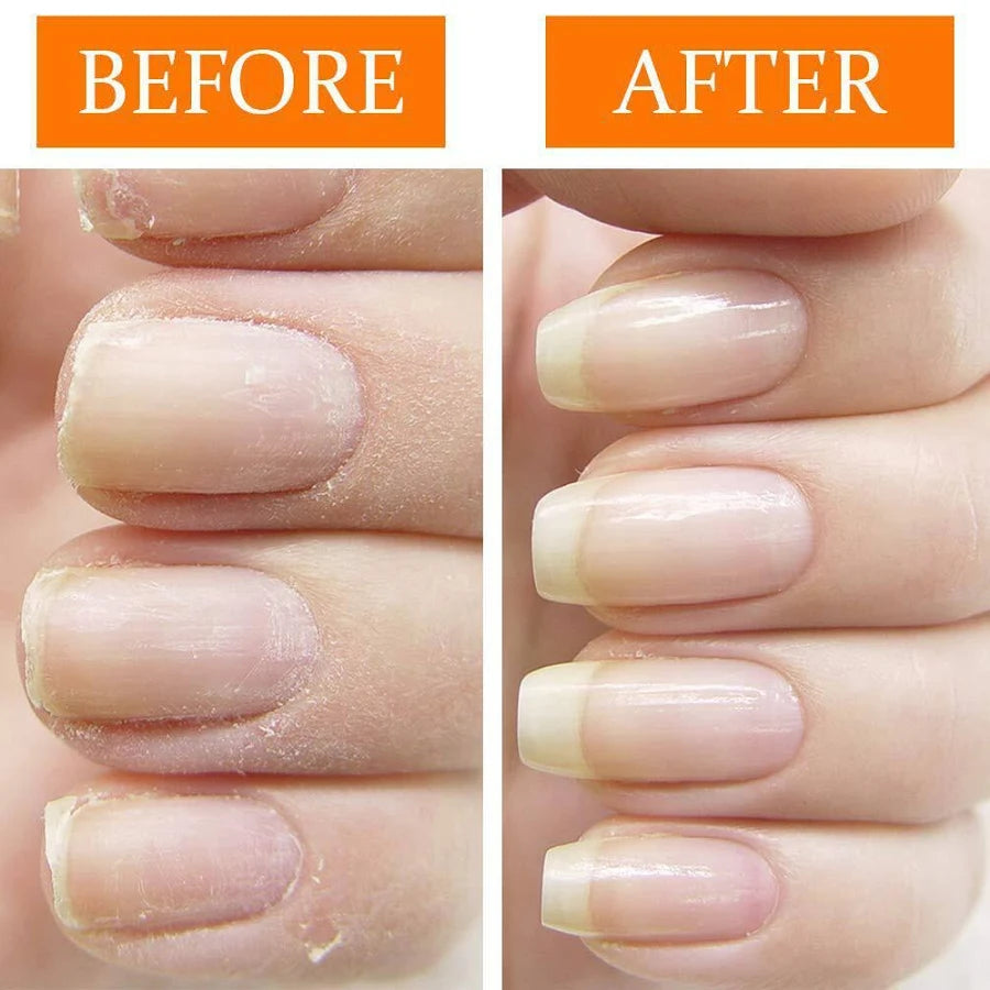Nail Tek - Nail Recovery System Kit For Soft Peeling Nails